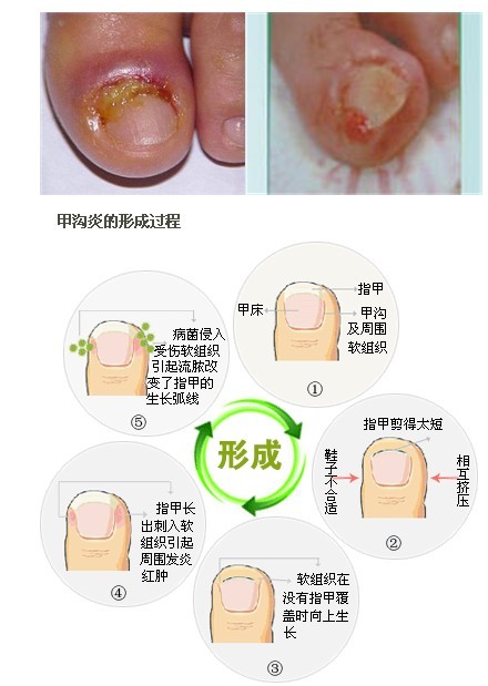 甲沟炎的产生原因有哪些呢?